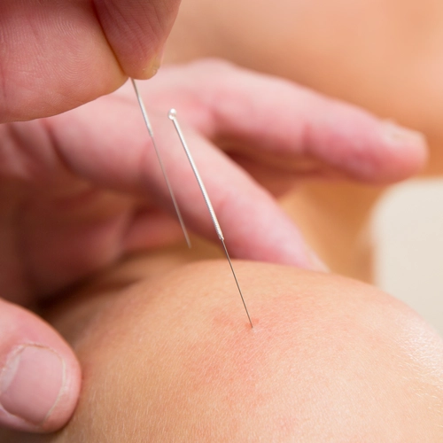 An acupuncture treatment being applied to a patient's shoulder